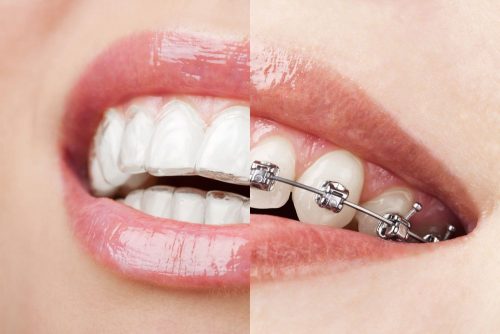 Invisalign - Invisible Braces